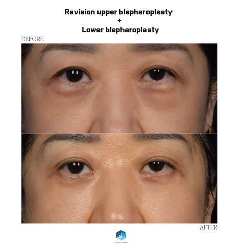 Lower Blepharoplasty + Upper Blepharoplasty before and after (revision surgery) — eye bag surgery and upper eyelid surgery for hooded eyes at SINSA L Plastic Surgery, Gangnam, Seoul, Korea · case 11