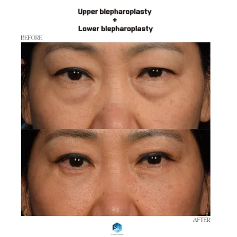 Lower Blepharoplasty + Upper Blepharoplasty before and after — eye bag surgery and upper eyelid surgery for hooded eyes at SINSA L Plastic Surgery, Gangnam, Seoul, Korea · case 22
