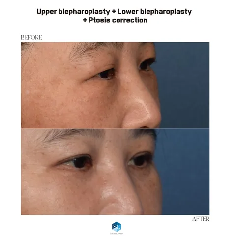 Lower Blepharoplasty + Upper Blepharoplasty + Ptosis Correction before and after — eye bag surgery and upper eyelid surgery for hooded eyes and droopy eyelid correction at SINSA L Plastic Surgery, Gangnam, Seoul, Korea · case 29