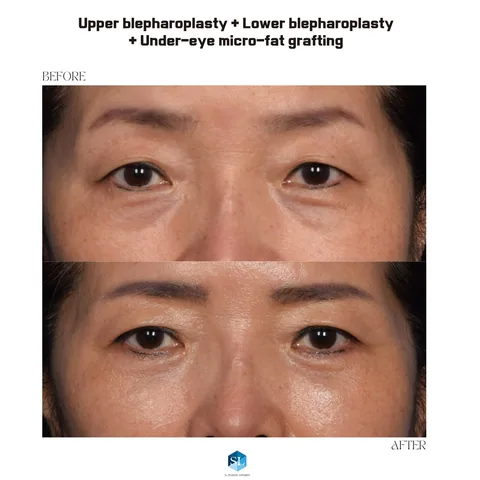 Lower Blepharoplasty + Micro Fat Grafting + Upper Blepharoplasty before and after — eye bag surgery and upper eyelid surgery for hooded eyes at SINSA L Plastic Surgery, Gangnam, Seoul, Korea · case 30