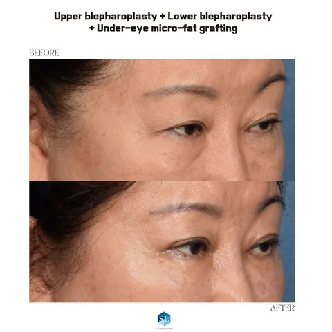 Lower Blepharoplasty + Micro Fat Grafting + Upper Blepharoplasty before and after — eye bag surgery and upper eyelid surgery for hooded eyes at SINSA L Plastic Surgery, Gangnam, Seoul, Korea · case 35