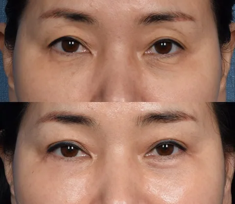 Lower Blepharoplasty + Micro Fat Grafting + Upper Blepharoplasty before and after — eye bag surgery and upper eyelid surgery for hooded eyes at SINSA L Plastic Surgery, Gangnam, Seoul, Korea · case 40