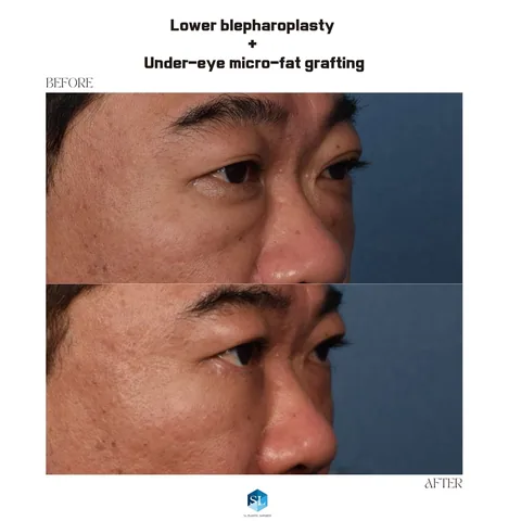 Lower Blepharoplasty + Micro Fat Grafting before and after — eye bag surgery at SINSA L Plastic Surgery, Gangnam, Seoul, Korea · case 47