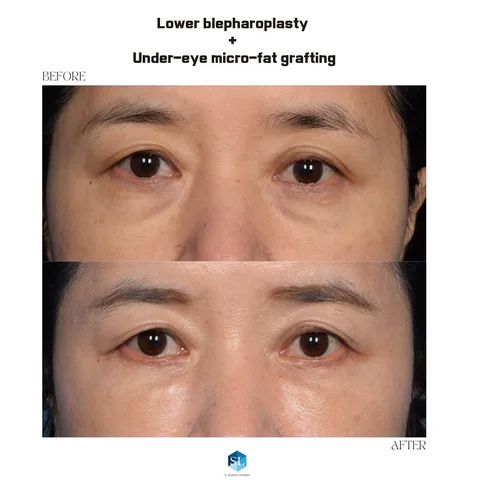 Lower Blepharoplasty + Micro Fat Grafting before and after — eye bag surgery at SINSA L Plastic Surgery, Gangnam, Seoul, Korea · case 48