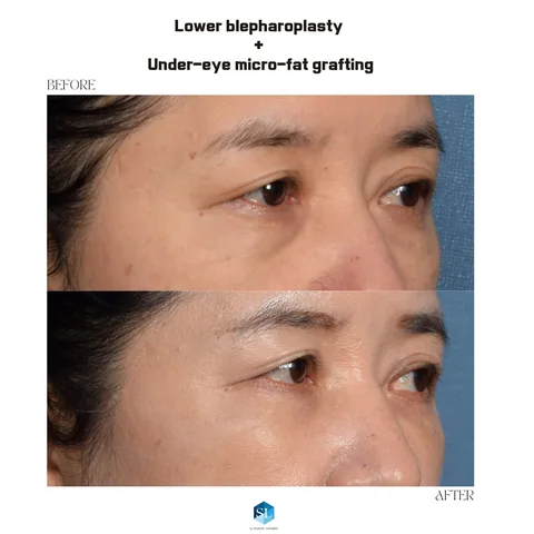 Lower Blepharoplasty + Micro Fat Grafting before and after — eye bag surgery at SINSA L Plastic Surgery, Gangnam, Seoul, Korea · case 49