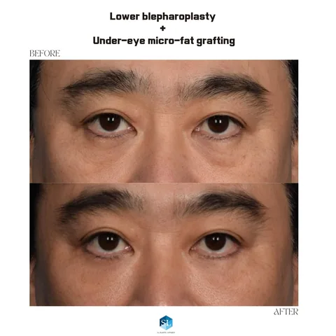 Lower Blepharoplasty + Micro Fat Grafting before and after — eye bag surgery at SINSA L Plastic Surgery, Gangnam, Seoul, Korea · case 54