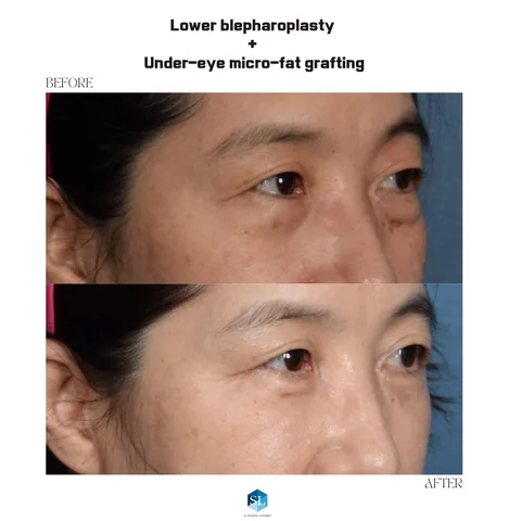 Lower Blepharoplasty + Micro Fat Grafting before and after — eye bag surgery at SINSA L Plastic Surgery, Gangnam, Seoul, Korea · case 57