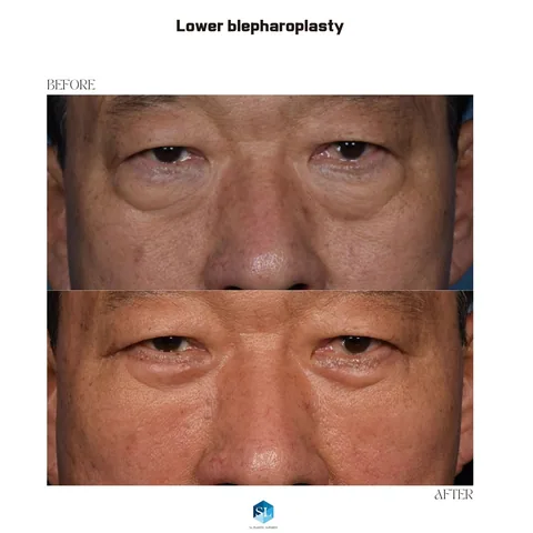 Lower Blepharoplasty before and after — eye bag surgery at SINSA L Plastic Surgery, Gangnam, Seoul, Korea · case 67