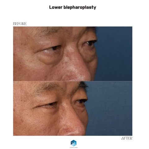 Lower Blepharoplasty before and after — eye bag surgery at SINSA L Plastic Surgery, Gangnam, Seoul, Korea · case 68