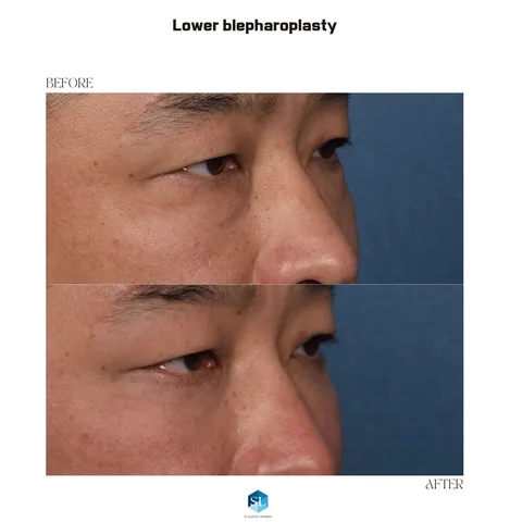 Lower Blepharoplasty before and after — eye bag surgery at SINSA L Plastic Surgery, Gangnam, Seoul, Korea · case 70