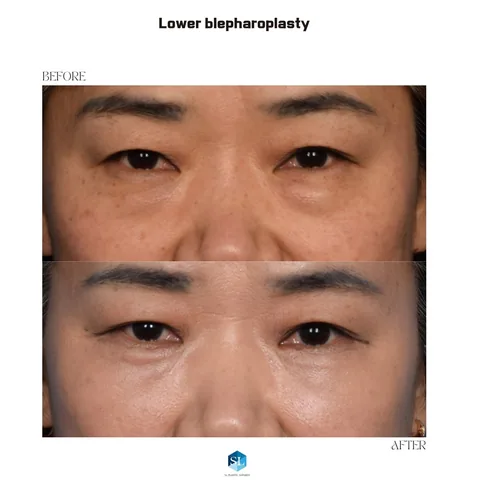 Lower Blepharoplasty before and after — eye bag surgery at SINSA L Plastic Surgery, Gangnam, Seoul, Korea · case 77