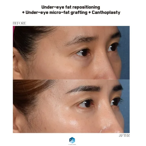 Under-Eye Fat Repositioning + Micro Fat Grafting + Canthoplasty before and after — eye bag surgery at SINSA L Plastic Surgery, Gangnam, Seoul, Korea · case 02