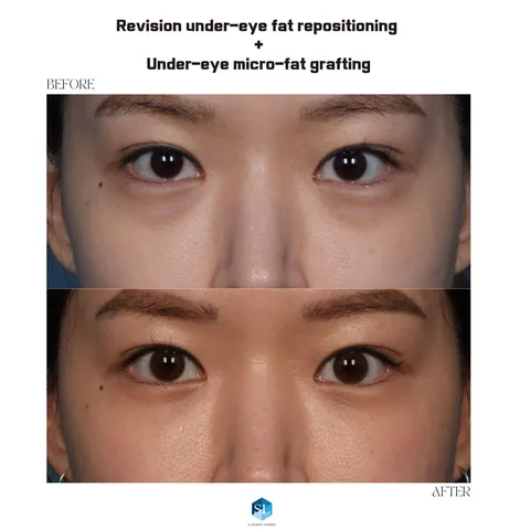 Under-Eye Fat Repositioning + Micro Fat Grafting before and after (revision surgery) — eye bag surgery at SINSA L Plastic Surgery, Gangnam, Seoul, Korea · case 05