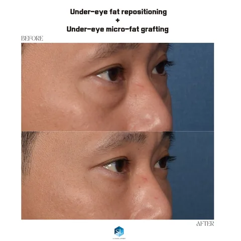 Under-Eye Fat Repositioning + Micro Fat Grafting before and after — eye bag surgery at SINSA L Plastic Surgery, Gangnam, Seoul, Korea · case 84