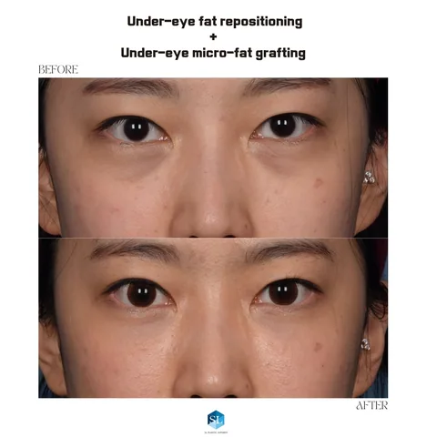Under-Eye Fat Repositioning + Micro Fat Grafting before and after — eye bag surgery at SINSA L Plastic Surgery, Gangnam, Seoul, Korea · case 85
