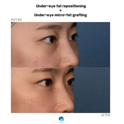 Under-Eye Fat Repositioning + Micro Fat Grafting before and after — eye bag surgery at SINSA L Plastic Surgery, Gangnam, Seoul, Korea · case 86