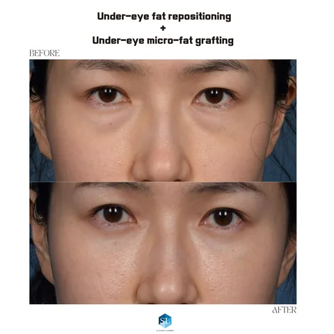 Under-Eye Fat Repositioning + Micro Fat Grafting before and after — eye bag surgery at SINSA L Plastic Surgery, Gangnam, Seoul, Korea · case 92