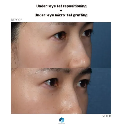 Under-Eye Fat Repositioning + Micro Fat Grafting before and after — eye bag surgery at SINSA L Plastic Surgery, Gangnam, Seoul, Korea · case 93