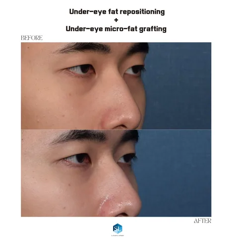 Under-Eye Fat Repositioning + Micro Fat Grafting before and after — eye bag surgery at SINSA L Plastic Surgery, Gangnam, Seoul, Korea · case 95