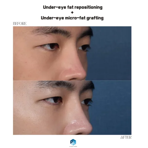 Under-Eye Fat Repositioning + Micro Fat Grafting before and after — eye bag surgery at SINSA L Plastic Surgery, Gangnam, Seoul, Korea · case 97