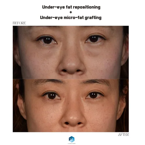 Under-Eye Fat Repositioning + Micro Fat Grafting before and after — eye bag surgery at SINSA L Plastic Surgery, Gangnam, Seoul, Korea · case 100