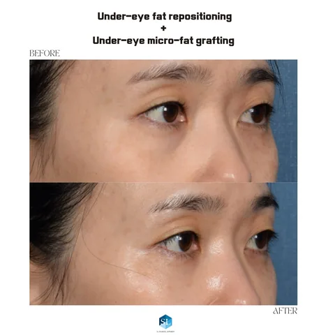 Under-Eye Fat Repositioning + Micro Fat Grafting before and after — eye bag surgery at SINSA L Plastic Surgery, Gangnam, Seoul, Korea · case 105