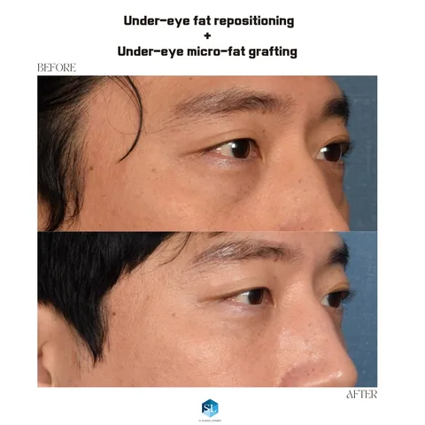 Under-Eye Fat Repositioning + Micro Fat Grafting before and after — eye bag surgery at SINSA L Plastic Surgery, Gangnam, Seoul, Korea · case 107