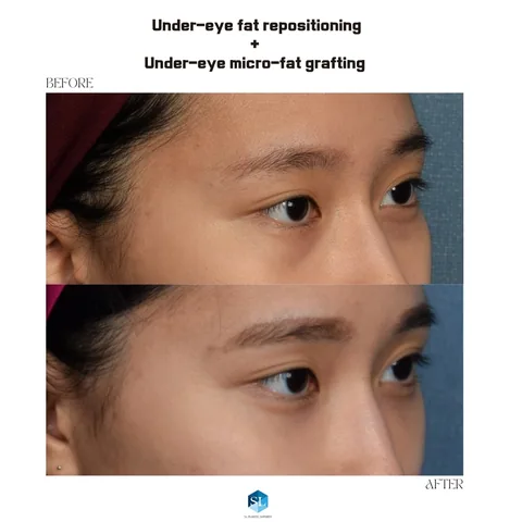 Under-Eye Fat Repositioning + Micro Fat Grafting before and after — eye bag surgery at SINSA L Plastic Surgery, Gangnam, Seoul, Korea · case 109