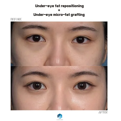 Under-Eye Fat Repositioning + Micro Fat Grafting before and after — eye bag surgery at SINSA L Plastic Surgery, Gangnam, Seoul, Korea · case 110