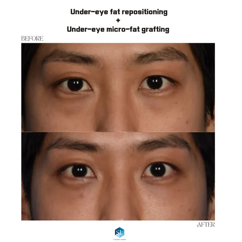 Under-Eye Fat Repositioning + Micro Fat Grafting before and after — eye bag surgery at SINSA L Plastic Surgery, Gangnam, Seoul, Korea · case 114