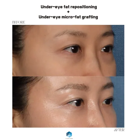 Under-Eye Fat Repositioning + Micro Fat Grafting before and after — eye bag surgery at SINSA L Plastic Surgery, Gangnam, Seoul, Korea · case 117