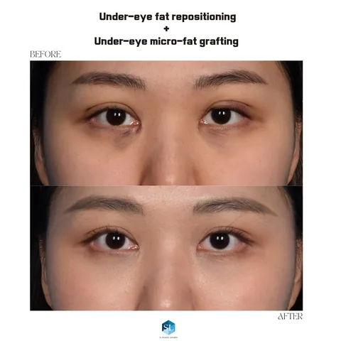Under-Eye Fat Repositioning + Micro Fat Grafting before and after — eye bag surgery at SINSA L Plastic Surgery, Gangnam, Seoul, Korea · case 122