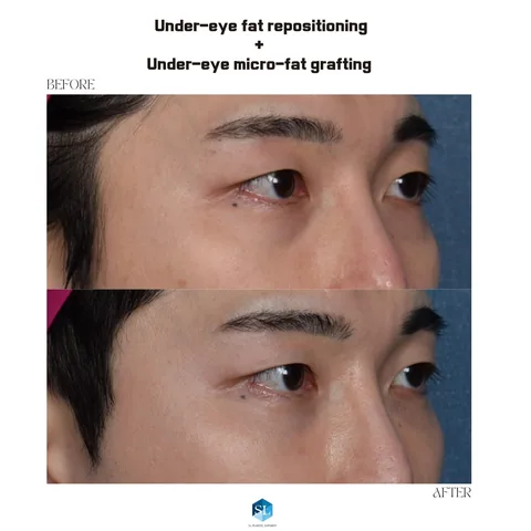 Under-Eye Fat Repositioning + Micro Fat Grafting before and after — eye bag surgery at SINSA L Plastic Surgery, Gangnam, Seoul, Korea · case 125