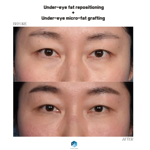 Under-Eye Fat Repositioning + Micro Fat Grafting before and after — eye bag surgery at SINSA L Plastic Surgery, Gangnam, Seoul, Korea · case 126