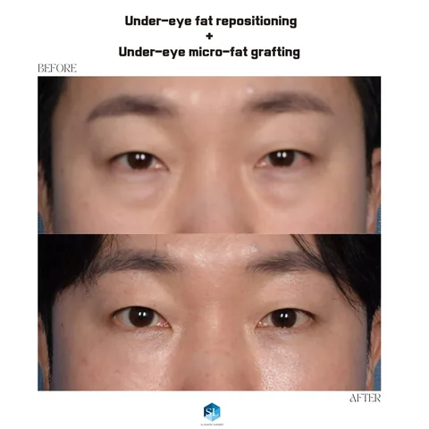 Under-Eye Fat Repositioning + Micro Fat Grafting before and after — eye bag surgery at SINSA L Plastic Surgery, Gangnam, Seoul, Korea · case 128