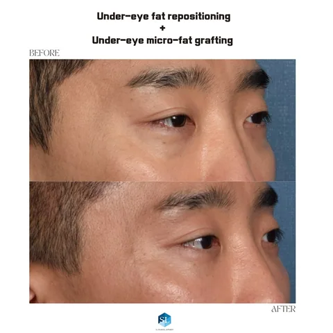 Under-Eye Fat Repositioning + Micro Fat Grafting before and after — eye bag surgery at SINSA L Plastic Surgery, Gangnam, Seoul, Korea · case 131