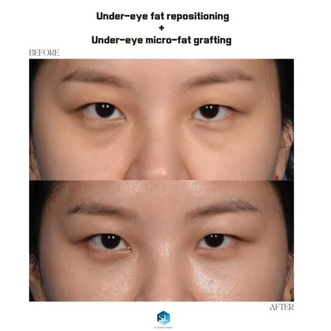 Under-Eye Fat Repositioning + Micro Fat Grafting before and after — eye bag surgery at SINSA L Plastic Surgery, Gangnam, Seoul, Korea · case 132