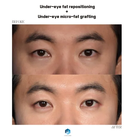 Under-Eye Fat Repositioning + Micro Fat Grafting before and after — eye bag surgery at SINSA L Plastic Surgery, Gangnam, Seoul, Korea · case 134