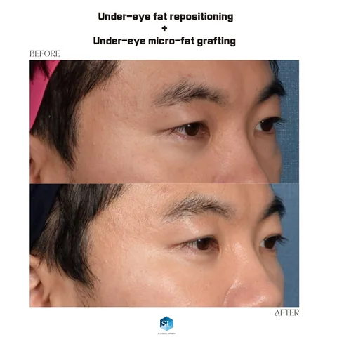 Under-Eye Fat Repositioning + Micro Fat Grafting before and after — eye bag surgery at SINSA L Plastic Surgery, Gangnam, Seoul, Korea · case 135