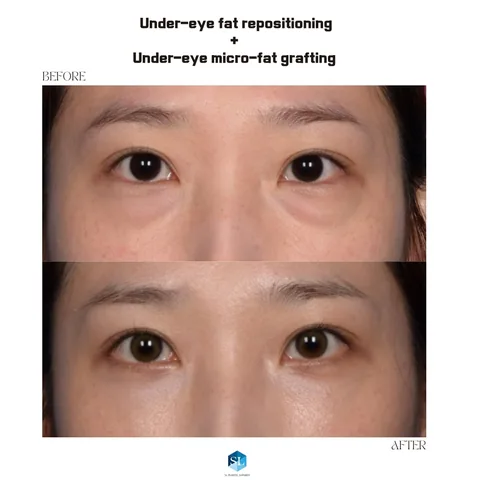 Under-Eye Fat Repositioning + Micro Fat Grafting before and after — eye bag surgery at SINSA L Plastic Surgery, Gangnam, Seoul, Korea · case 136
