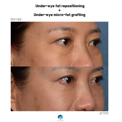 Under-Eye Fat Repositioning + Micro Fat Grafting before and after — eye bag surgery at SINSA L Plastic Surgery, Gangnam, Seoul, Korea · case 141