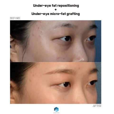 Under-Eye Fat Repositioning + Micro Fat Grafting before and after — eye bag surgery at SINSA L Plastic Surgery, Gangnam, Seoul, Korea · case 145