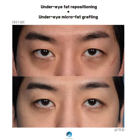 Under-Eye Fat Repositioning + Micro Fat Grafting before and after — eye bag surgery at SINSA L Plastic Surgery, Gangnam, Seoul, Korea · case 146