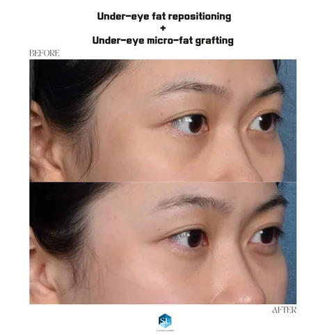 Under-Eye Fat Repositioning + Micro Fat Grafting before and after — eye bag surgery at SINSA L Plastic Surgery, Gangnam, Seoul, Korea · case 149