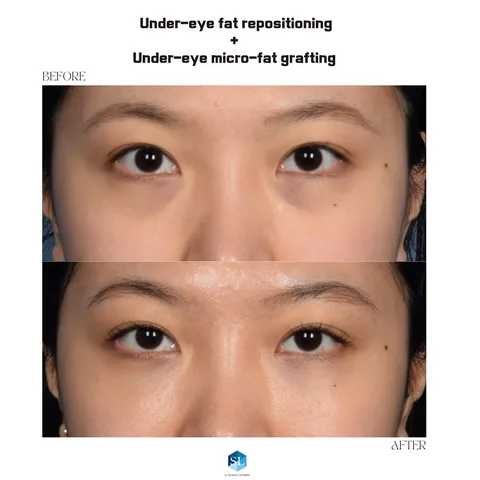Under-Eye Fat Repositioning + Micro Fat Grafting before and after — eye bag surgery at SINSA L Plastic Surgery, Gangnam, Seoul, Korea · case 150