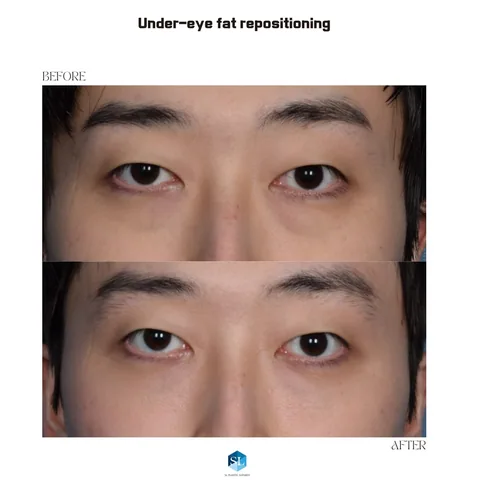 Under-Eye Fat Repositioning before and after — eye bag surgery at SINSA L Plastic Surgery, Gangnam, Seoul, Korea · case 153