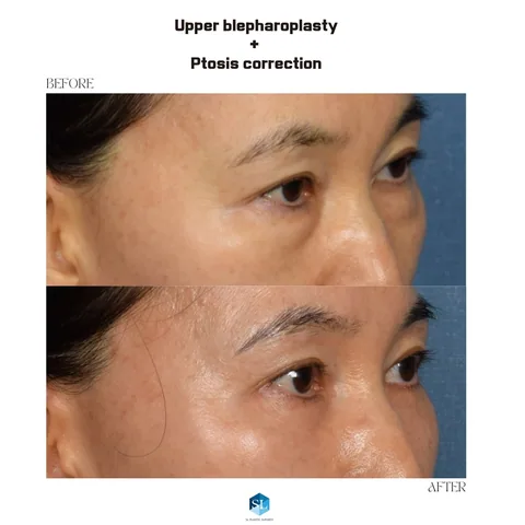 Upper Blepharoplasty + Ptosis Correction before and after — upper eyelid surgery for hooded eyes and droopy eyelid correction at SINSA L Plastic Surgery, Gangnam, Seoul, Korea · case 14