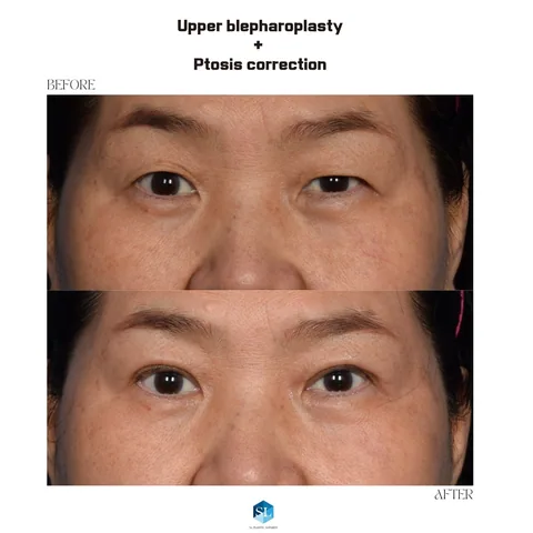 Upper Blepharoplasty + Ptosis Correction before and after — upper eyelid surgery for hooded eyes and droopy eyelid correction at SINSA L Plastic Surgery, Gangnam, Seoul, Korea · case 15