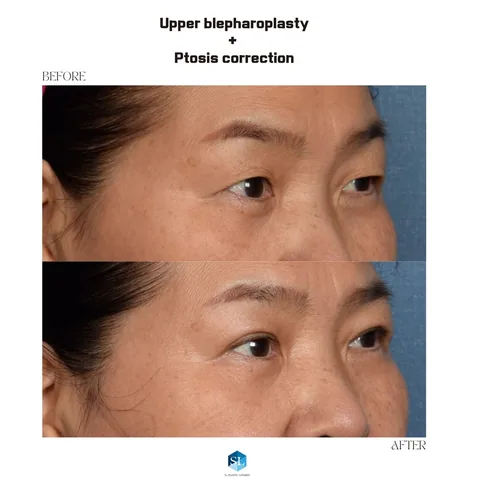 Upper Blepharoplasty + Ptosis Correction before and after — upper eyelid surgery for hooded eyes and droopy eyelid correction at SINSA L Plastic Surgery, Gangnam, Seoul, Korea · case 16